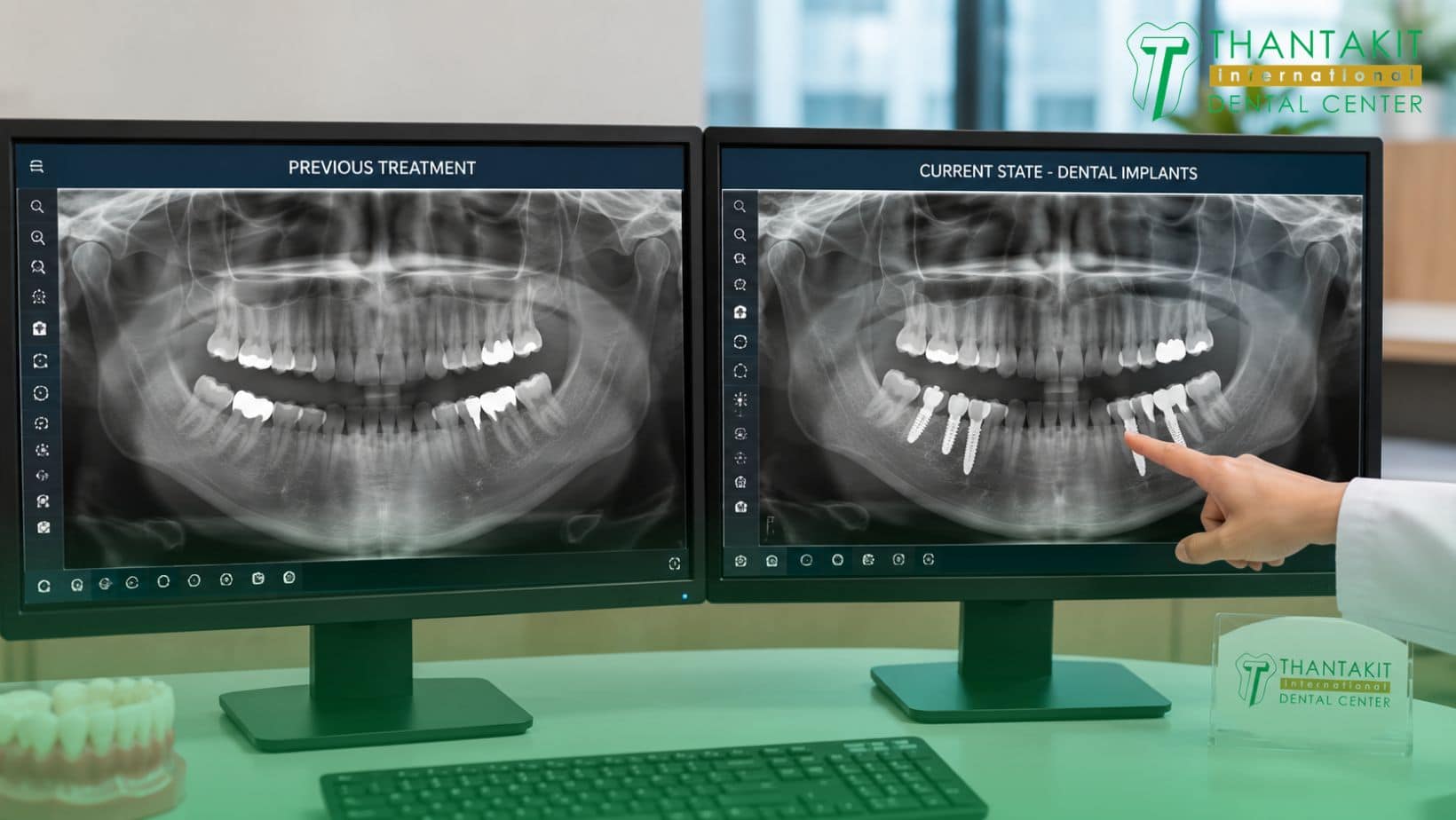 When Is the Right Time to Consider Dental Implants