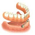 dental implants