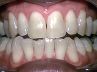 teeth whitening bangkok plasma
