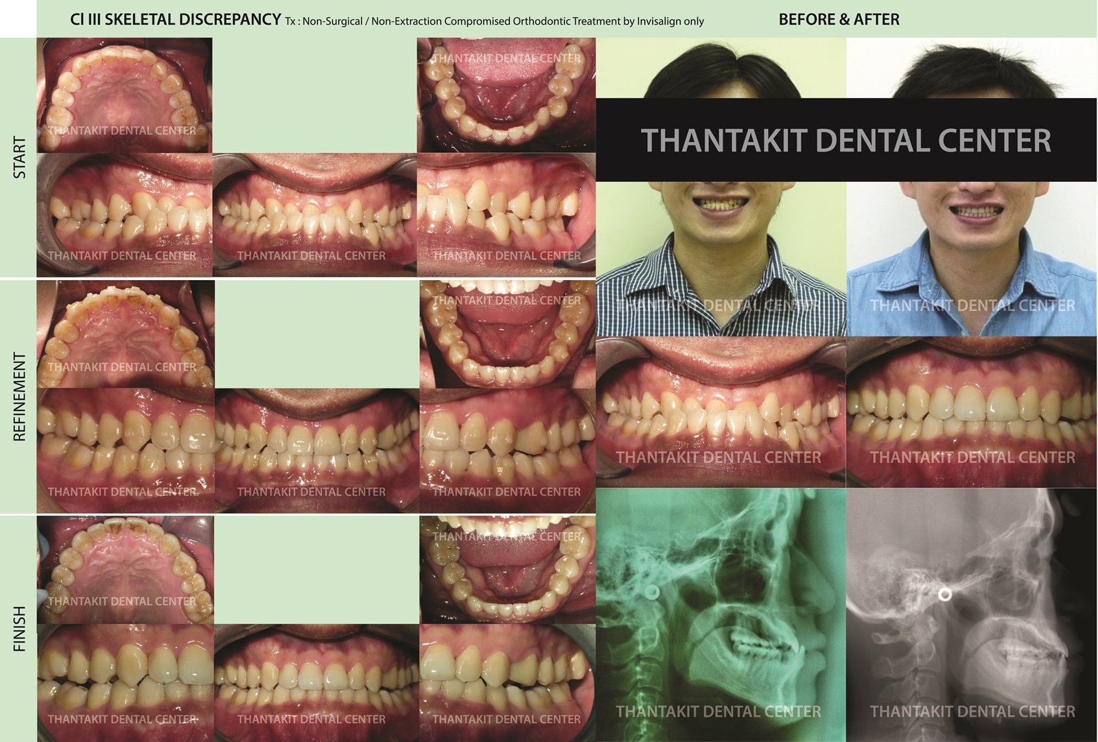 Invisalign (Clear Aligners) in Bangkok, Thailand