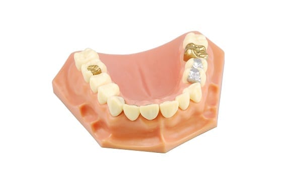 how do metal fillings work