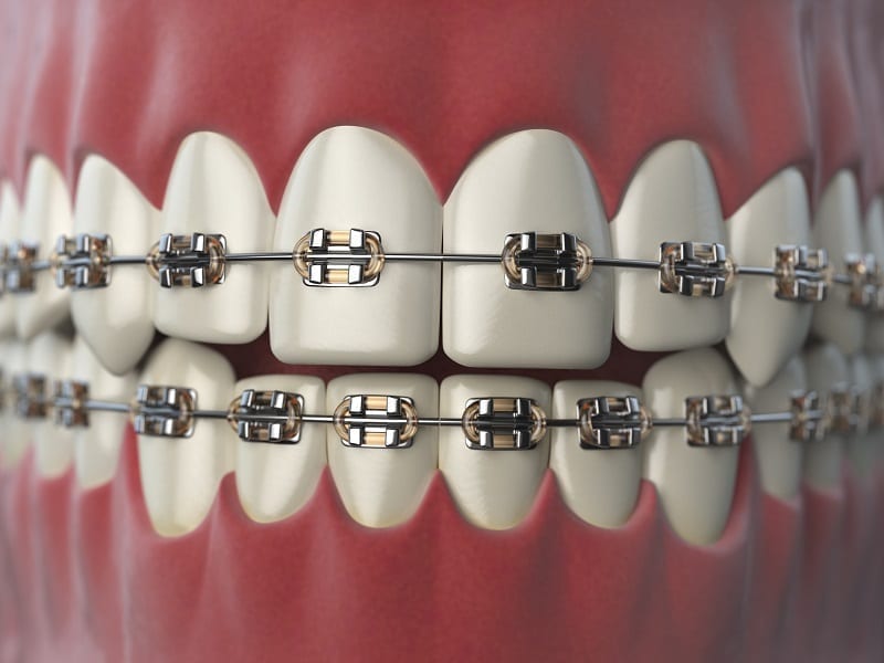 Affordable Dental Braces for Adults: A Comprehensive Guide