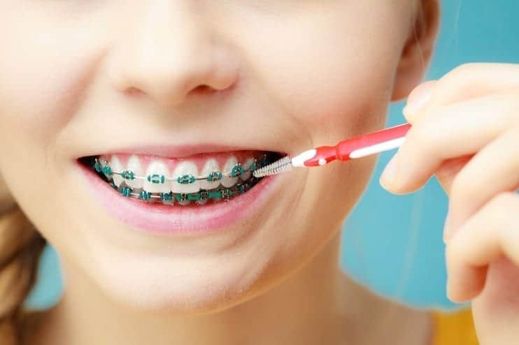 How Much Do Braces Cost?, Braces Price