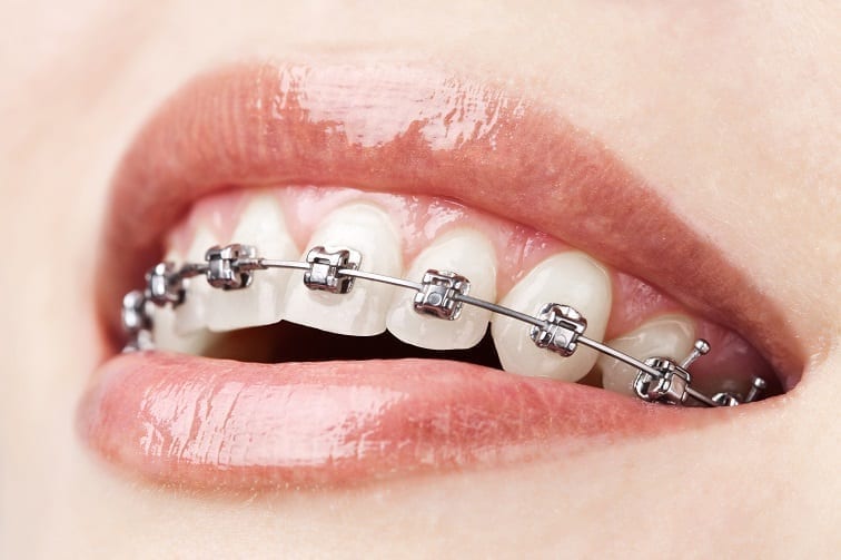Premium Photo  Alignment of crooked teeth with the help of braces