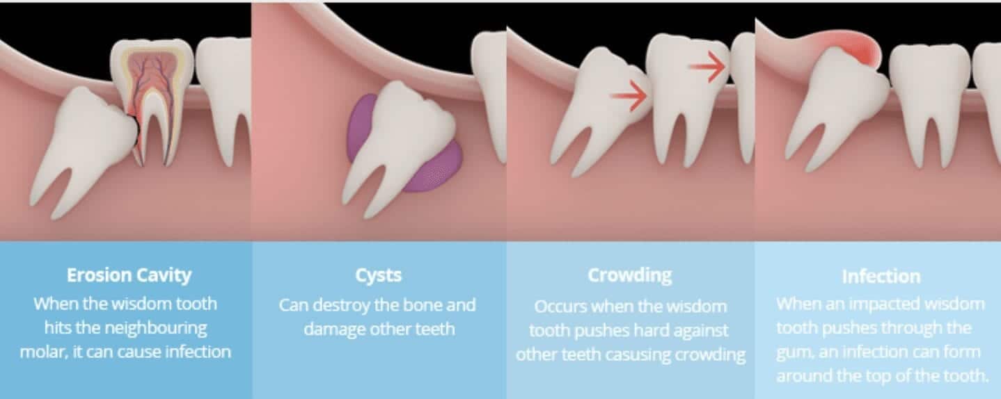 Wisdom Tooth Extraction/Removal in Bangkok, Thailand