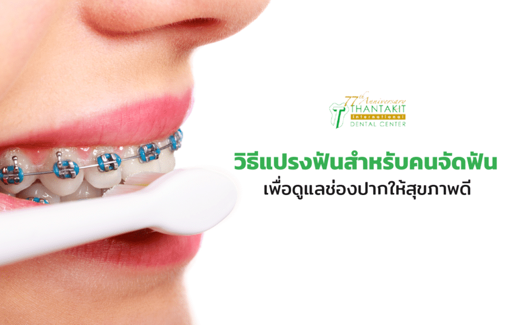 วิธีแปรงฟันสำหรับคนจัดฟัน