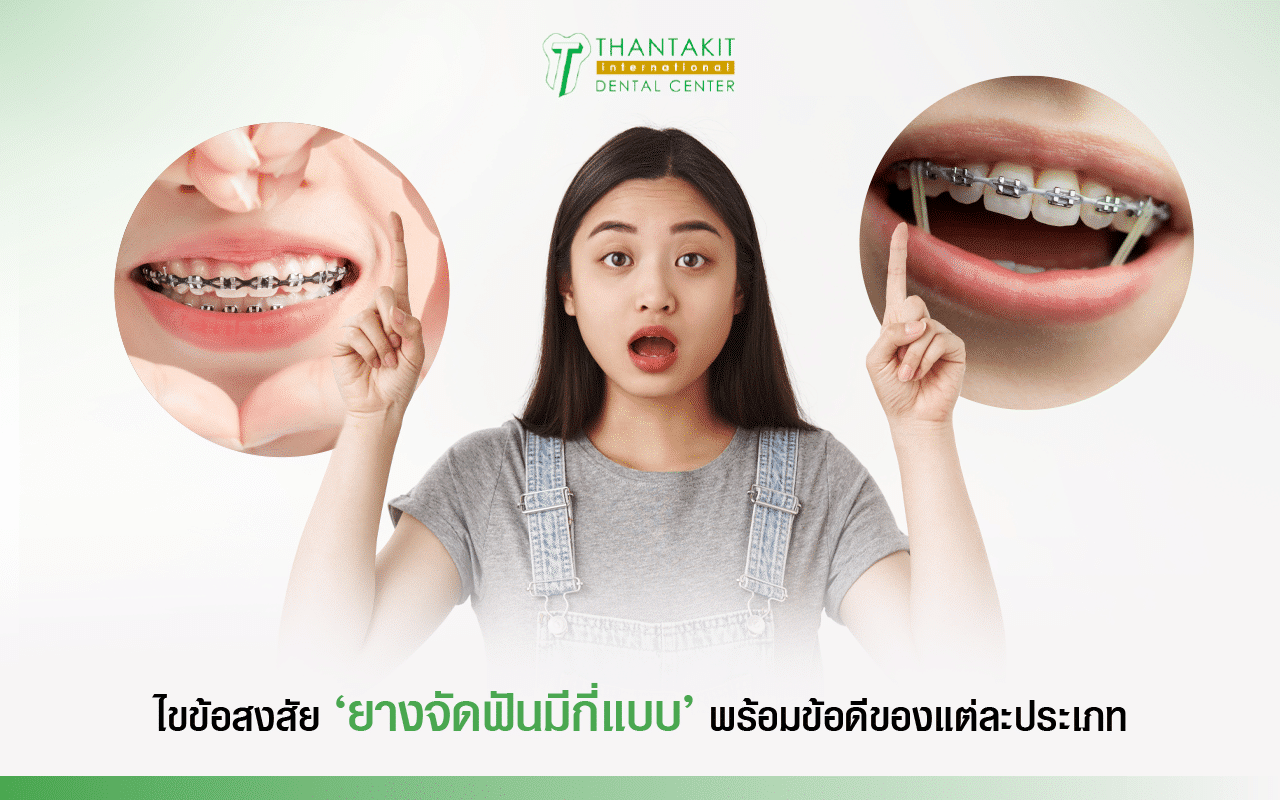 รวมข้อมูล ยางจัดฟัน ทุกแบบ แบบไหนที่ใช่สำหรับคุณ