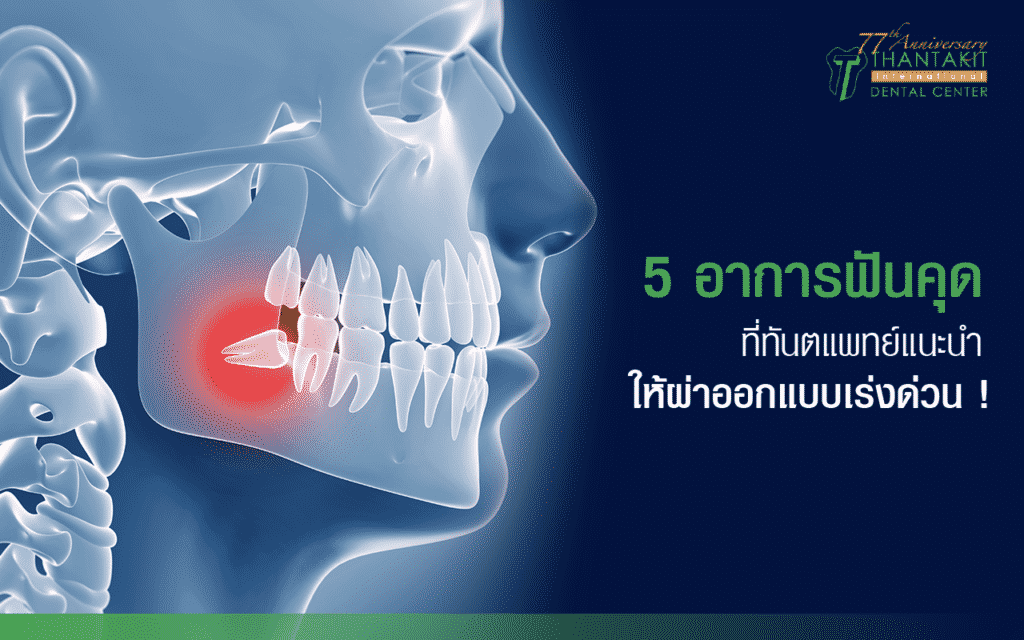 ฟันคุดแบบไหนไม่ต้องผ่า