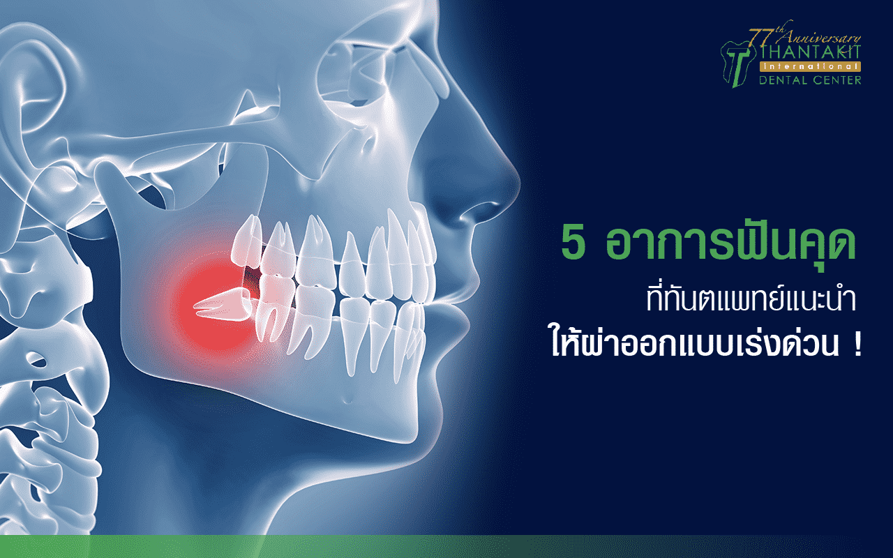 5 อาการฟันคุดที่ทันตแพทย์แนะนำให้ผ่าออกแบบเร่งด่วน!