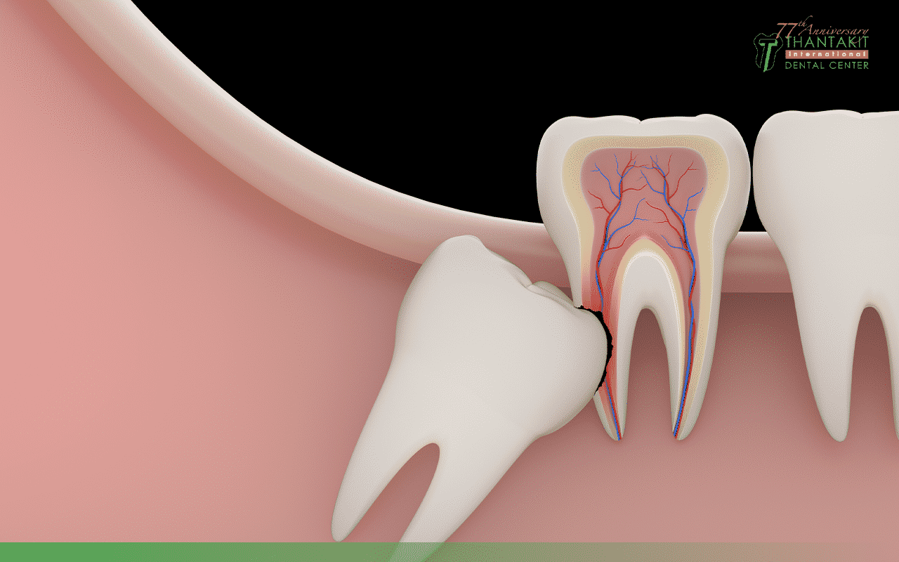 5 อาการฟันคุดที่ทันตแพทย์แนะนำให้ผ่าออกแบบเร่งด่วน!