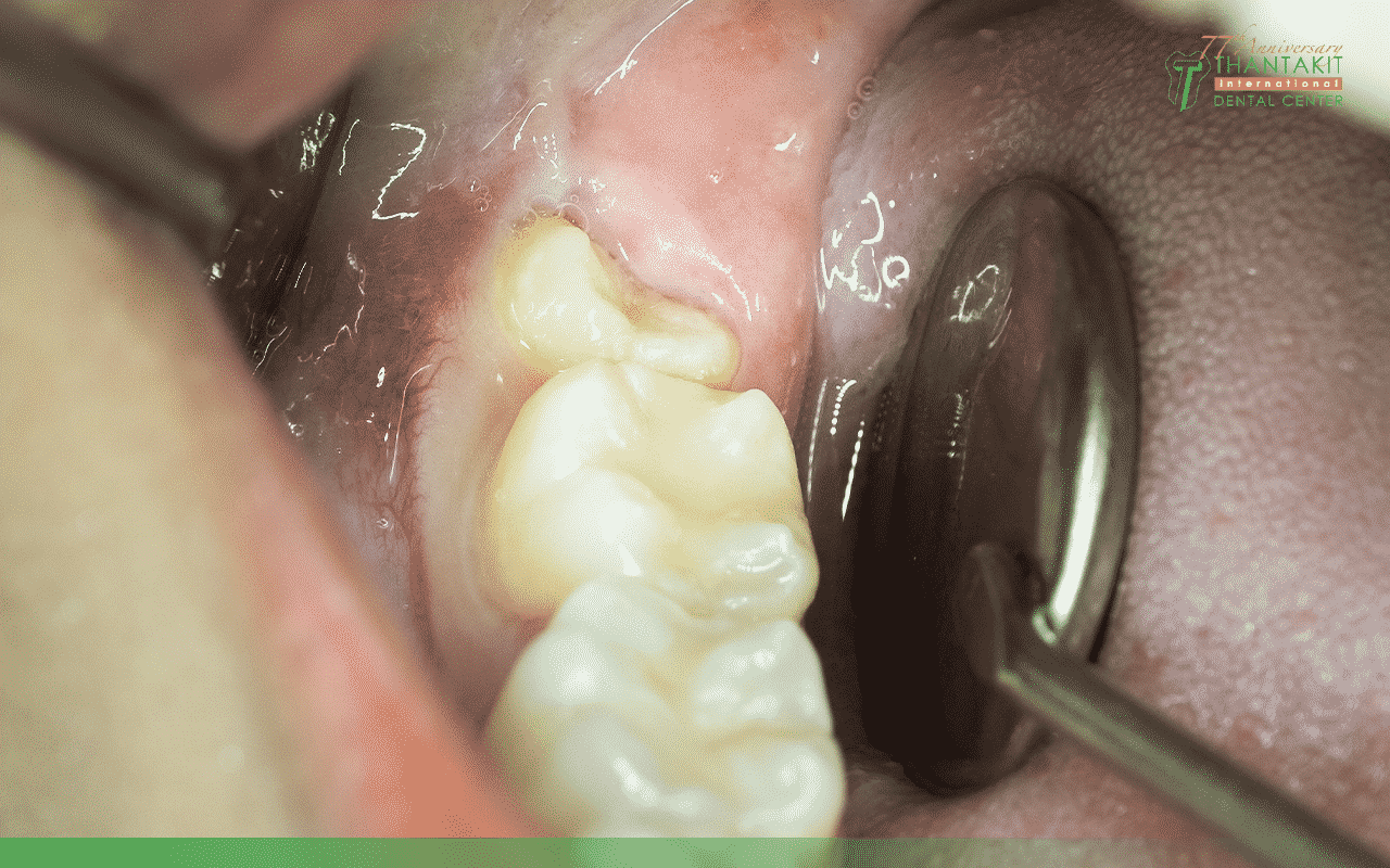 5 อาการฟันคุดที่ทันตแพทย์แนะนำให้ผ่าออกแบบเร่งด่วน!
