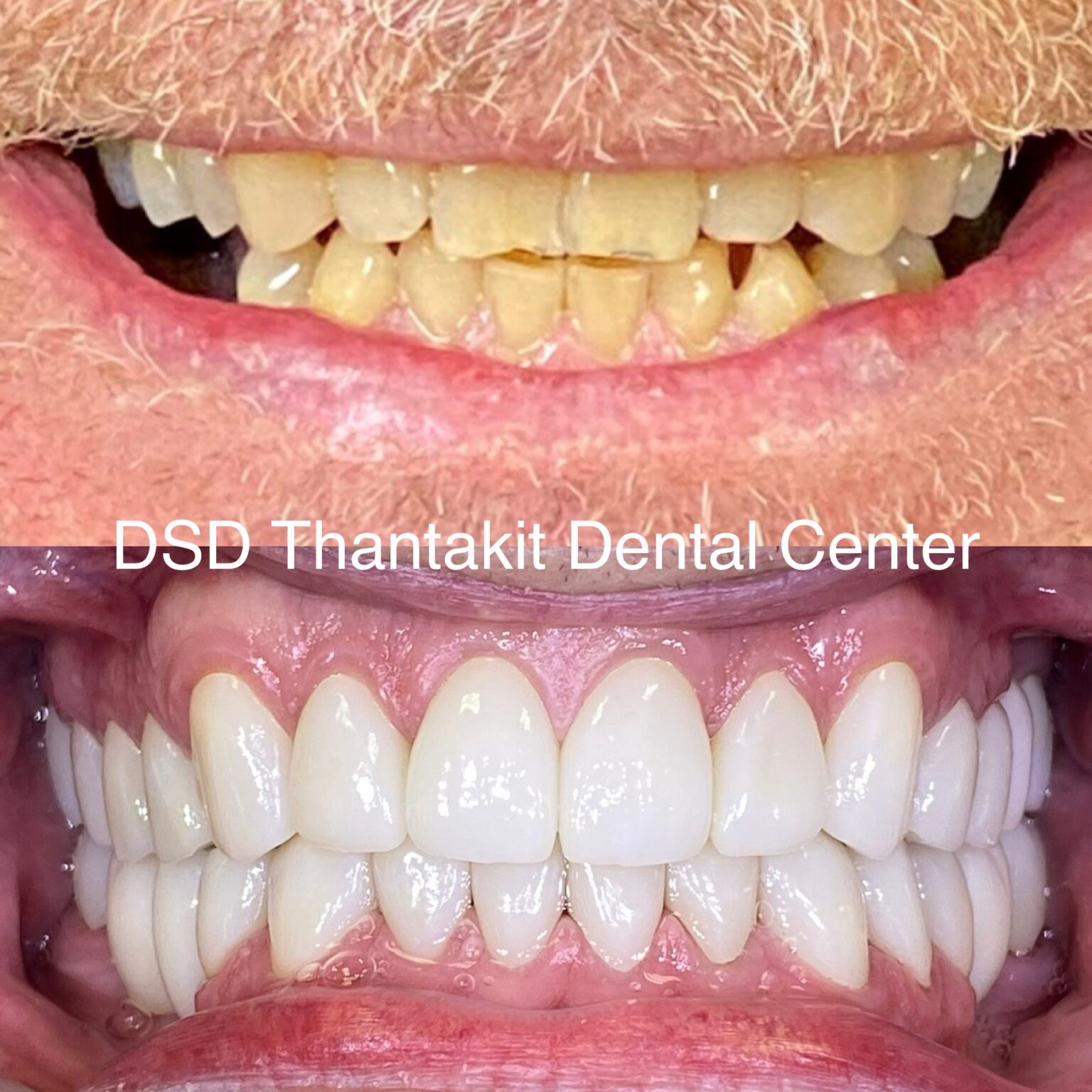 Cosmetic Dental Work Cases at Thantakit Dental Center
