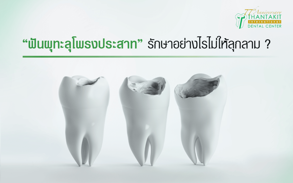 ฟันผุทะลุโพรงประสาท ฟันผุทะลุโพรงประสาท
