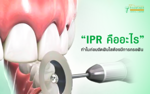 IPR คือ