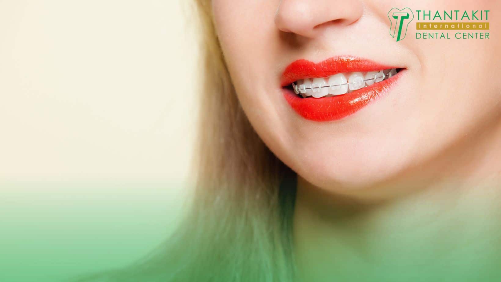 Ceramic Braces (Pros, Cons & Costs) - NewMouth