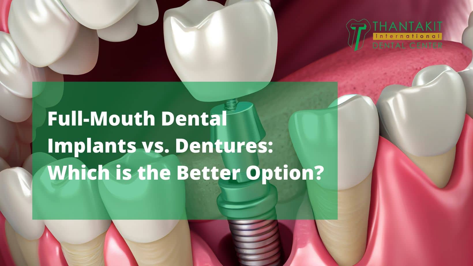 Full-Mouth Dental Implants vs. Dentures Which is the Better Option