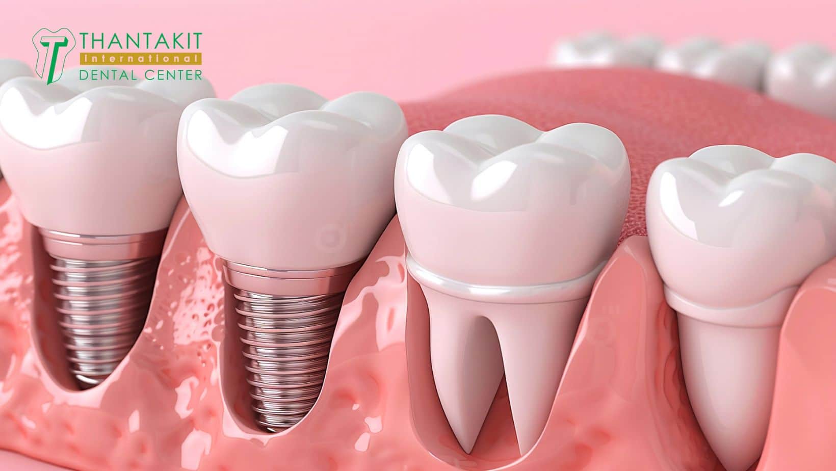 The Argument for Implants