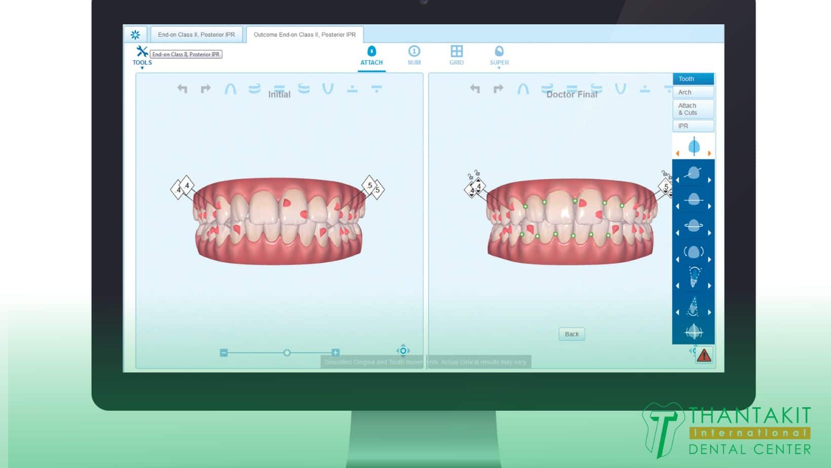 How Long Do Dental Fillings Last