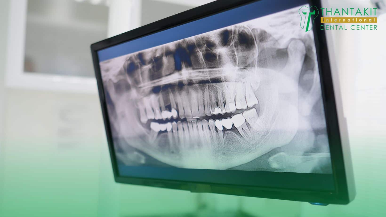 What Is a Dental CT Scan (CBCT)